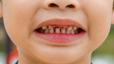 Gigi Berlubang pada Anak, Kenali Bahaya hingga Cara Mengatasinya