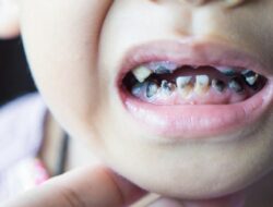 Seputar Gigi Gigis pada Anak, Mulai dari Penyebab hingga Cara Merawatnya