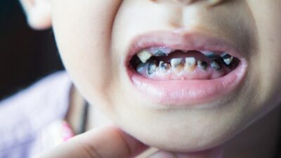 Seputar Gigi Gigis pada Anak, Mulai dari Penyebab hingga Cara Merawatnya